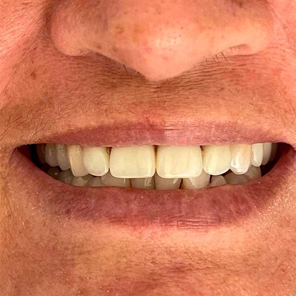 clinica-de-odontologia-em-campina-grande,-dentista-em-campina-grande,-implante-dentario,-implante-dentario-em-campina-grande,-protese-dentaria,-dra-marilia-pessoa-t3