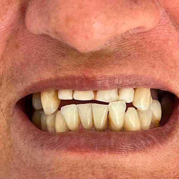 clinica-de-odontologia-em-campina-grande,-dentista-em-campina-grande,-implante-dentario,-implante-dentario-em-campina-grande,-protese-dentaria,-dra-marilia-pessoa-t4 clinica-de-odontologia-em-campina-grande,-dentista-em-campina-grande,-implante-dentario,-implante-dentario-em-campina-grande,-protese-dentaria,-dra-marilia-pessoa-t4