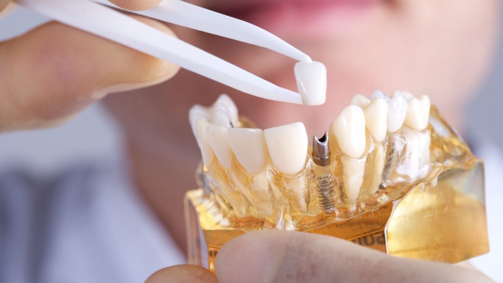 como é colocado o implante dentário, dentista em campina grande, melhor dentista em campina grande, implante dentario, clínica odontológica campina grande
