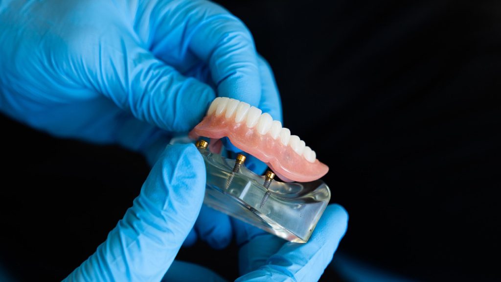 Implante ou Dentadura? O Que Escolher